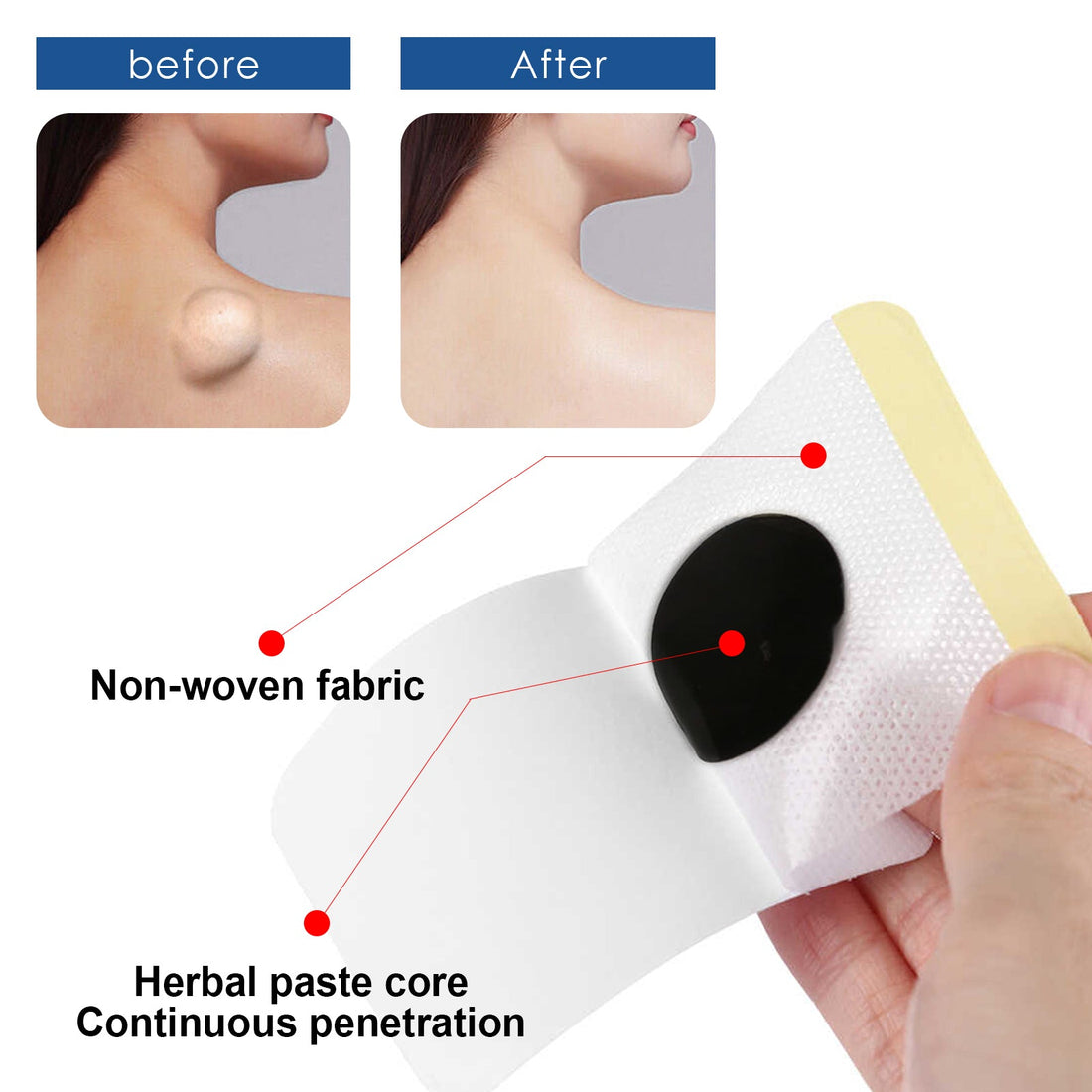 Lipoma Removal Patch – Subcutaneous Lump Care