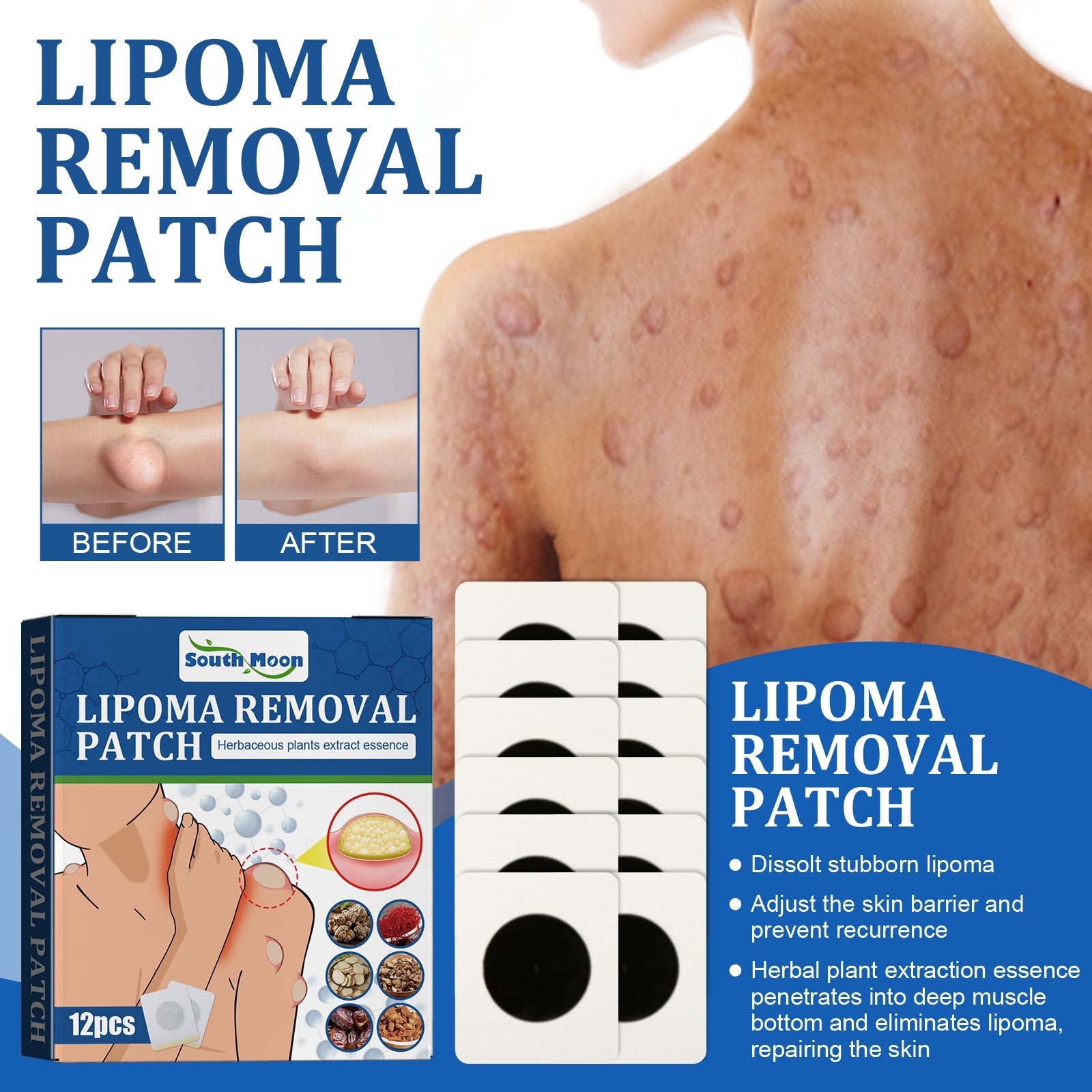 Lipoma Removal Patch – Subcutaneous Lump Care